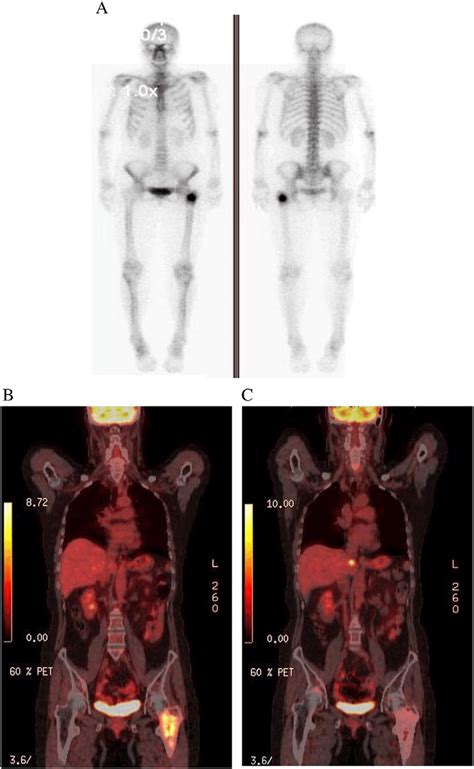 initial  body bone scan demonstrating  single abnormality