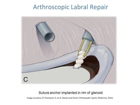 Shoulder Labral Tear Labral Repair And Rehabilitation Ashvin K Dewan Md