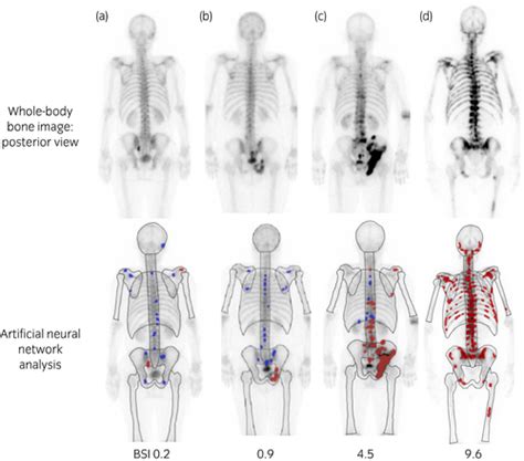 Bone Scan Index A New Biomarker Of Bone Metastasis In Patients With