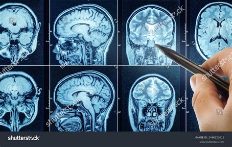 ct scan brain doctors hand medical stock photo  shutterstock