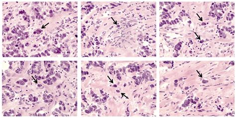 Estcs In Invasive Breast Carcinoma Of No Special Type Arrows Download Scientific Diagram