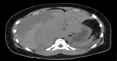 Hellp Syndrome Complicated By Subcapsular Liver Hematoma A Medicine Case Reports And