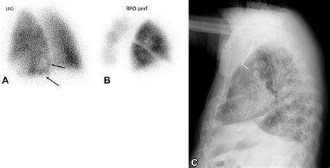 Ventilation Perfusion Scan A Primer For Practicing Radiologists