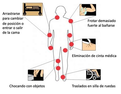 Patient Education Skin Tear Spanish