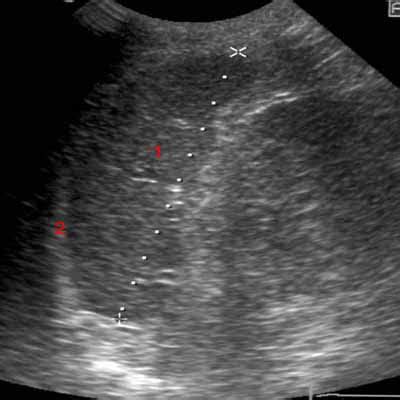 Abdominal ultrasound