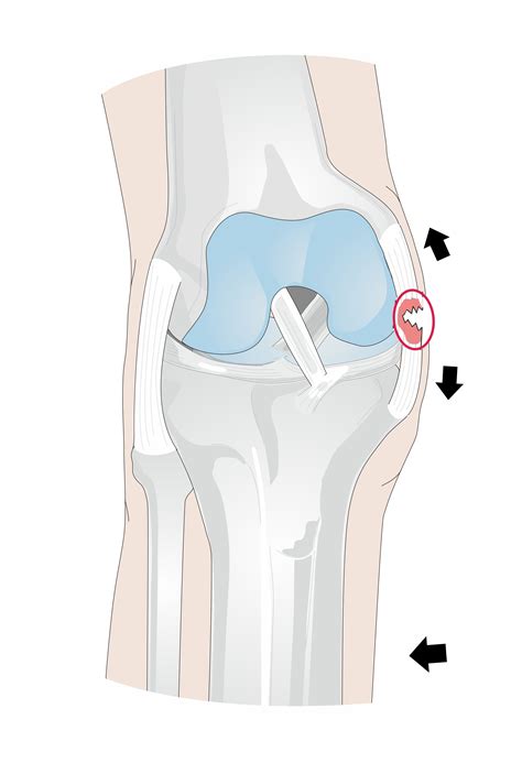 Grade 2 Ligament Tear - Ligament Sprain Physiopedia : Grade 2 usually ...