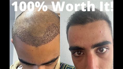 How Much Is A Hair Transplant In Turkey Cost Breakdown Youtube