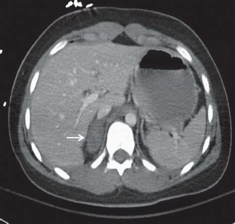 Adrenal Hemorrhage Radiology Key