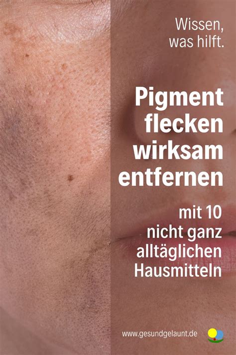 Pigmentflecken wirksam entfernen mit 10 nicht ganz alltäglichen