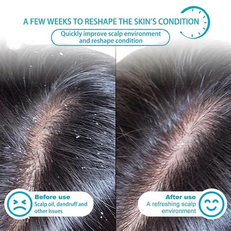 Seborrheic Dermatitis Psoriasis Shampoo-scalp For Folliculitis