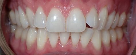 Spectacular Invisalign Results: Before and Afters Images