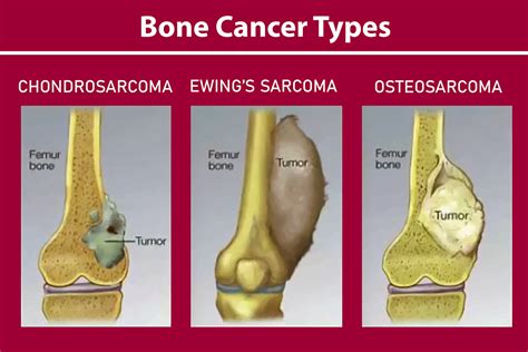 bone cancer estecharat