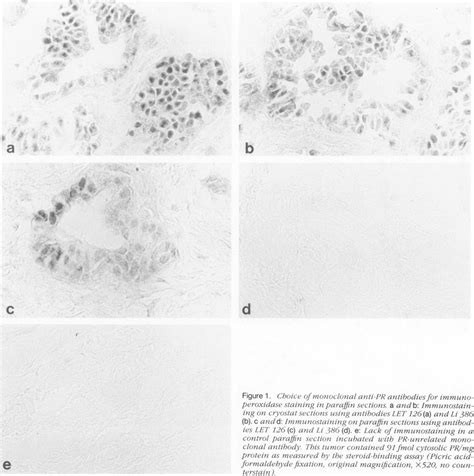 Cboice Ofmonoclonal Anti Pr Antibodiesfor Immunoperoxidase Staining In