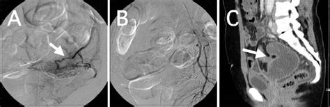 Case 3 Showing Postoperative Hemorrhage After Laparoscopic Assisted