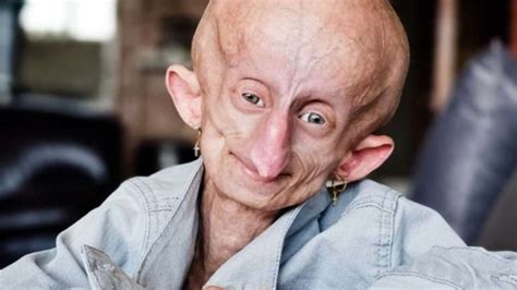 O Que E Progeria