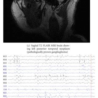 EEG of a 37-year-old right-handed male with complex partial seizures ...