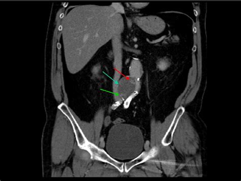 Figure From Imaging Of Endoleaks After Endovascular Aneurysm Repair