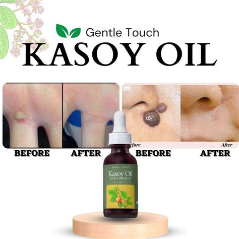 Gentle Touch Original And Effective Kasoy Oil For Warts Kulogo