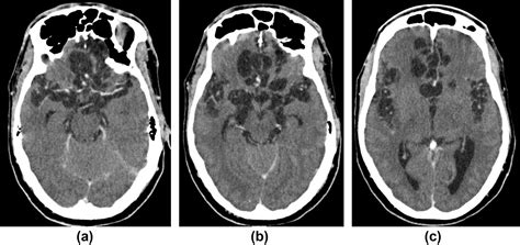 Imaging Of Neurocysticercosis And The Influence Of The Human