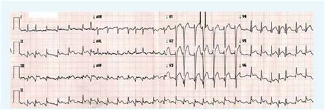 EKG dos días después del alta. Fibrilación auricular con respuesta