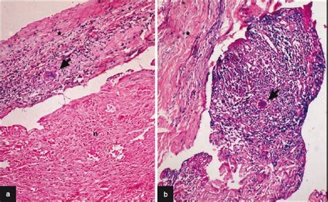 A Large Zones Of Caseous Necrosis N Seen With Overlying Dura Infi Download Scientific