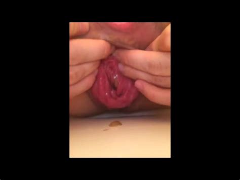Anal Prolapse ThisVid