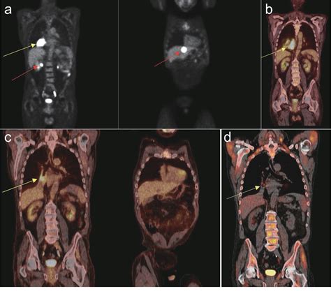 Figure 2 From Successful Treatment Of Refractory Post Transplant