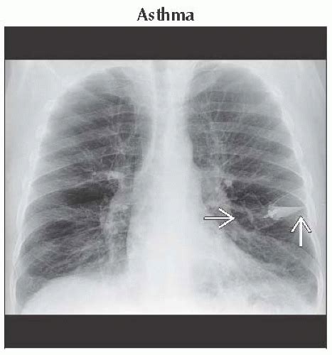Wheezing Thoracic Key