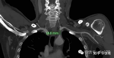 锁骨下动脉盗血综合征 知乎