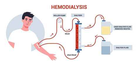 3 Types Of Vascular Access Ports Used In Hemodialysis