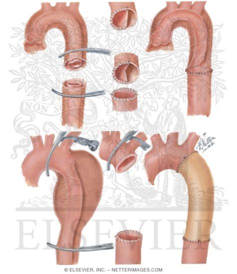 Surgery of Aorta