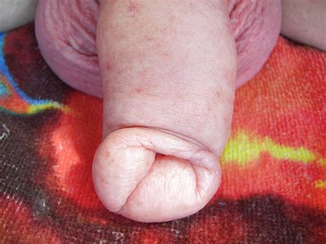 Foreskin Porn Pics PICTOA