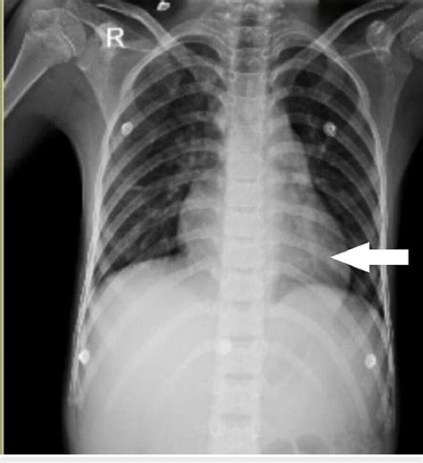 Chest X Ray Of The Patient Revealed Cardiomegaly Download Scientific