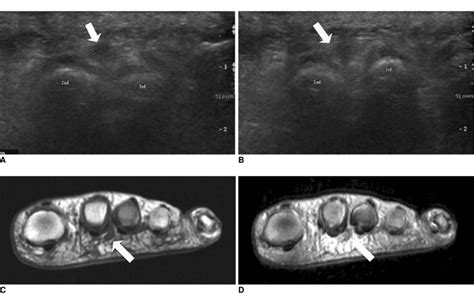 Foot Neuroma Ultrasound