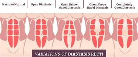 Diastasis Recti And Hernia Whats The Difference And How To Treat