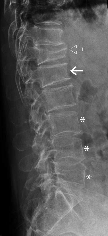 Severe Osteoporosis X Ray