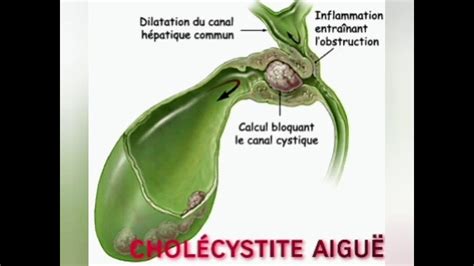 Cholécystite Aiguë Cours Pathologies Chirurgicales Ifcs Ispits Youtube