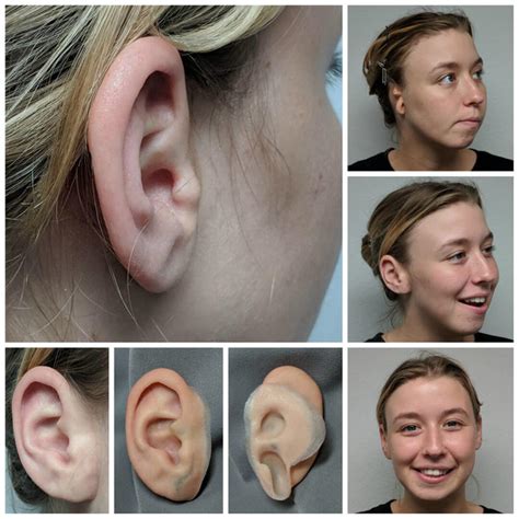 Microtia Photo Gallery Medical Art Prosthetics