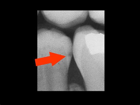 Radiographic Diagnosis Of Dental Caries