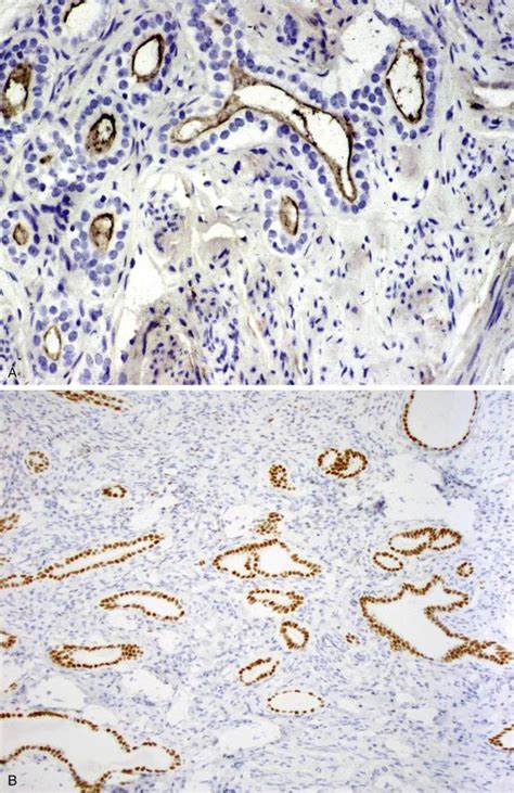 Immunohistochemistry And Molecular Diagnostics In The Differential