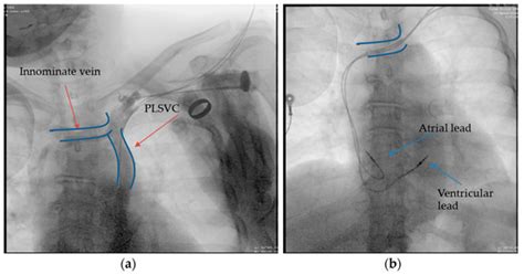 Diagnostics Free Full Text Cardiac Implantable Electronic Devices In Different Anatomical