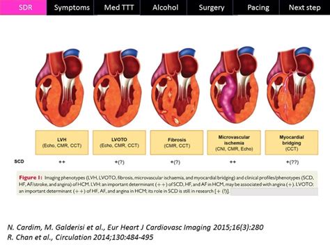 Cardiomyopathie Hypertrophique Apport De L Imagerie