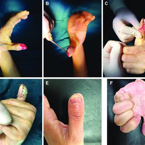 One Typical Case With Ulnar Oblique Defect In His Thumb A B