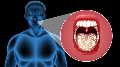 Oral Cancer Early Detection Diagnosis And Staging