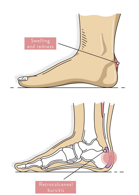 Heel Pain: Causes, Treatment & Prevention | Podiatry Sydney