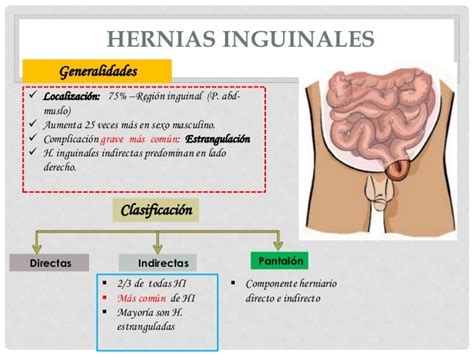 Hernias Abdominales Hernia Femoral Hernia Inguinal