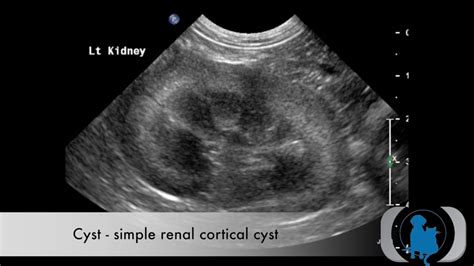 Renal Ultrasound Made Easy Step By Step Guide Artofit