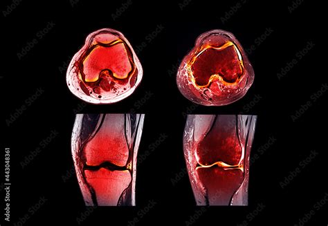 Magnetic Resonance Imaging Or Mri Knee Joint Comparison Coronal And