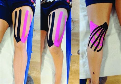 Application Pattern Of The Kinesio Tape During The First 2 Weeks The