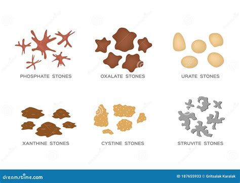 Types Of Kidney Stone 6 Set Stock Vector Illustration Of Infection